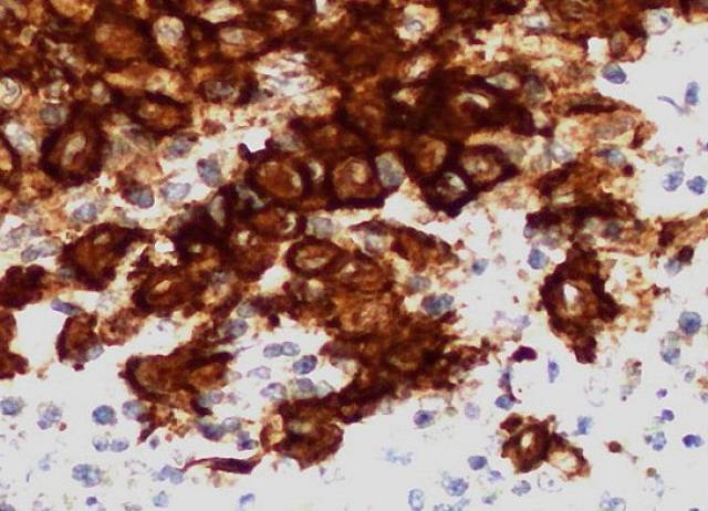 Células Langerhans CD1+